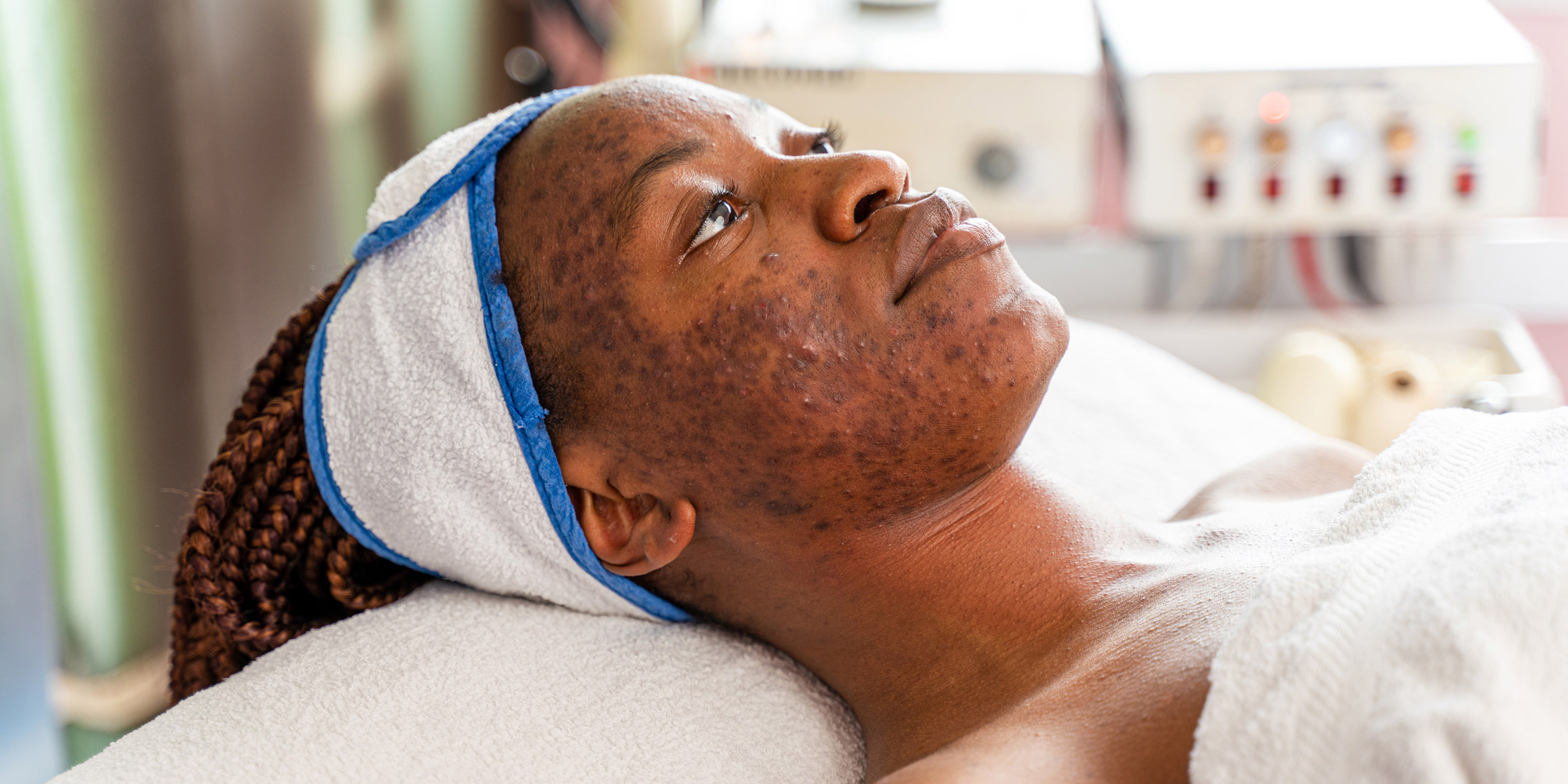 Comment traiter l'hyperpigmentation pour une peau éclatante?