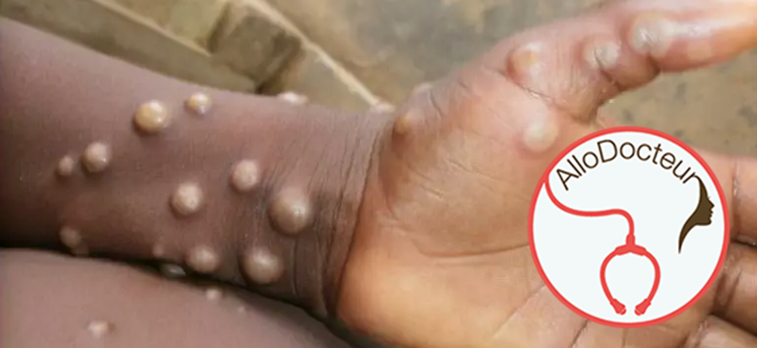 Quels sont les symptômes de la variole du singe ?