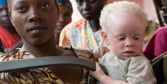 Albinos au Malawi : une nouvelle vague de violences