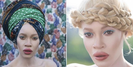 Diandra Forrest, premier mannequin albinos égérie d`une grande marque de beauté