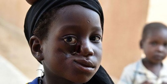 Côte d`ivoire: rendre le sourire aux victimes du noma, maladie qui défigure et exclut