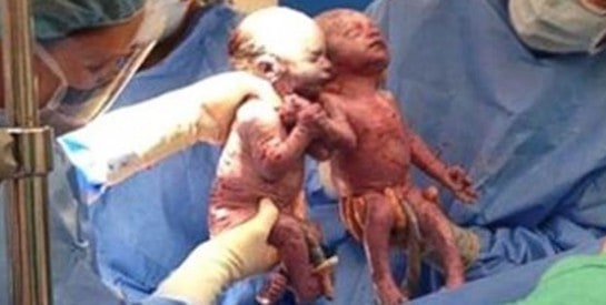 Des jumelles naissent en se tenant par la main