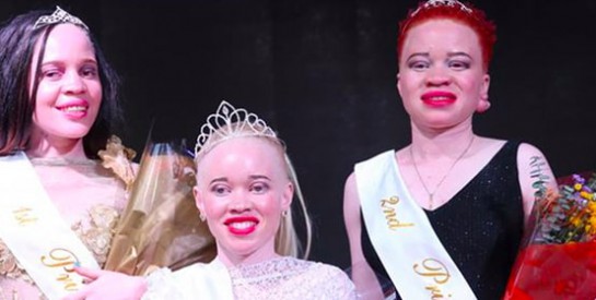 Zimbabwe : des reines de beauté albinos pour lutter contre les préjugés