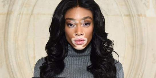 À la rencontre de Winnie Harlow, une mannequin atteinte de vitiligo qui enflamme les podiums