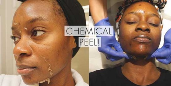 Peelings du visage : améliorer l`éclat et traiter les imperfections de la peau