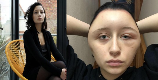Défigurée après une coloration pour cheveux, Estelle, 19 ans, a frôlé la mort