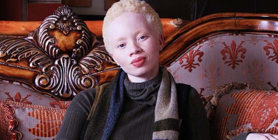 Un mannequin albinos pour la première fois en couverture de Vogue