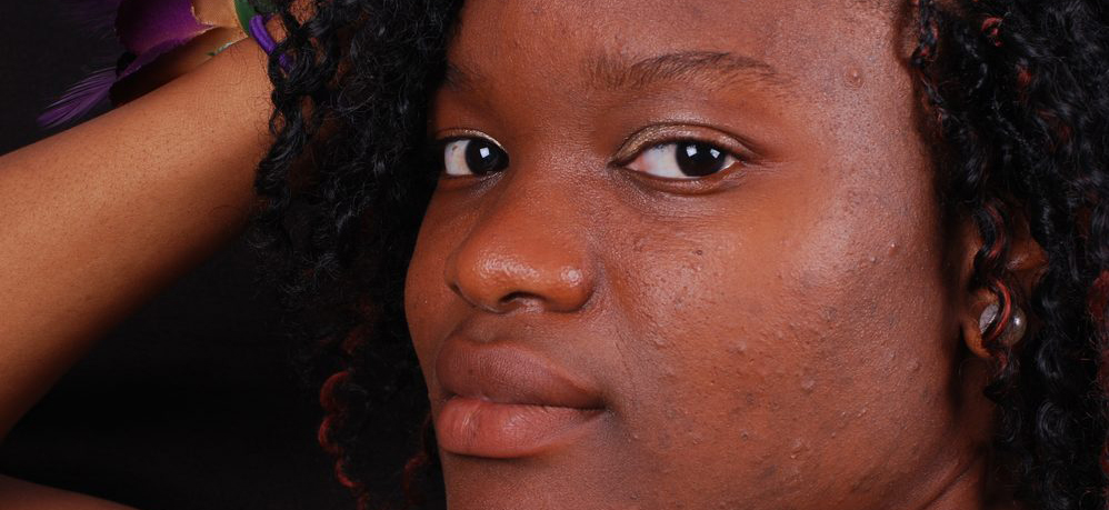 Quelles solutions pour limiter les rougeurs et imperfections liées à l’acné ?