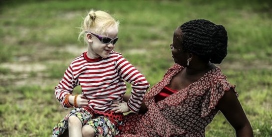Meurtres d'albinos : Plus de 200 sorciers arrêtés en Tanzanie