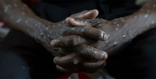 Les premiers vaccins contre le mpox arrivent jeudi en République démocratique du Congo