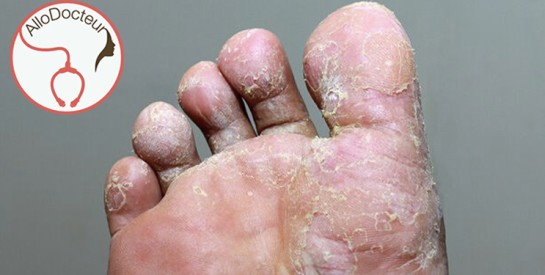 Allo Docteur : ''Mes pieds d’athlète ne finissent pas, que faire ?''