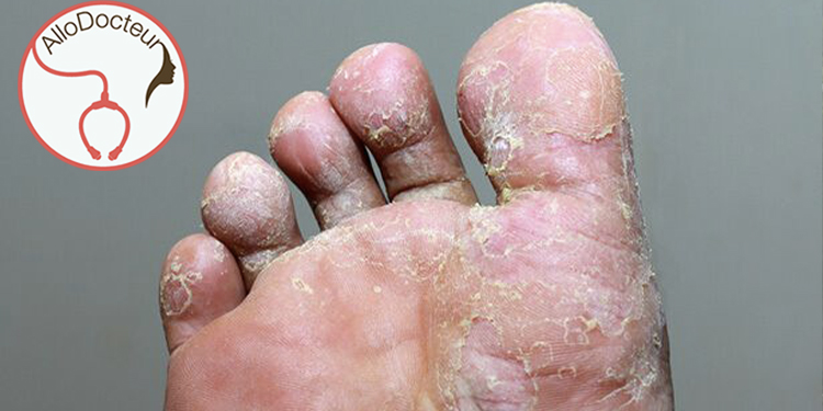 Allo Docteur : ''Mes pieds d’athlète ne finissent pas, que faire ?''