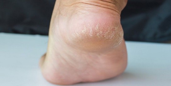 Talons secs et fendillés : les astuces de grand-mère pour retrouver des pieds tout doux