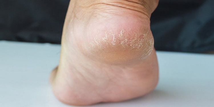Talons secs et fendillés : les astuces de grand-mère pour retrouver des pieds tout doux