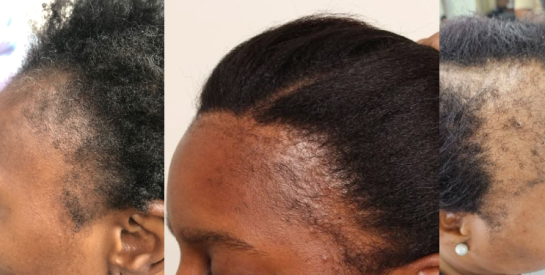 5 erreurs qui empêchent vos cheveux crépus de bien pousser