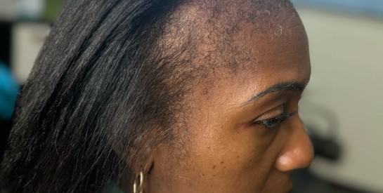 Vous perdez beaucoup de cheveux au démêlage ? Ces gestes méritent votre attention