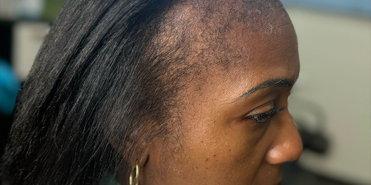 Vous perdez beaucoup de cheveux au démêlage ? Ces gestes méritent votre attention