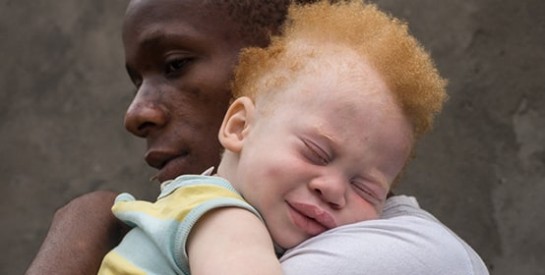 Au Malawi, recrudescence d`attaques contre les albinos